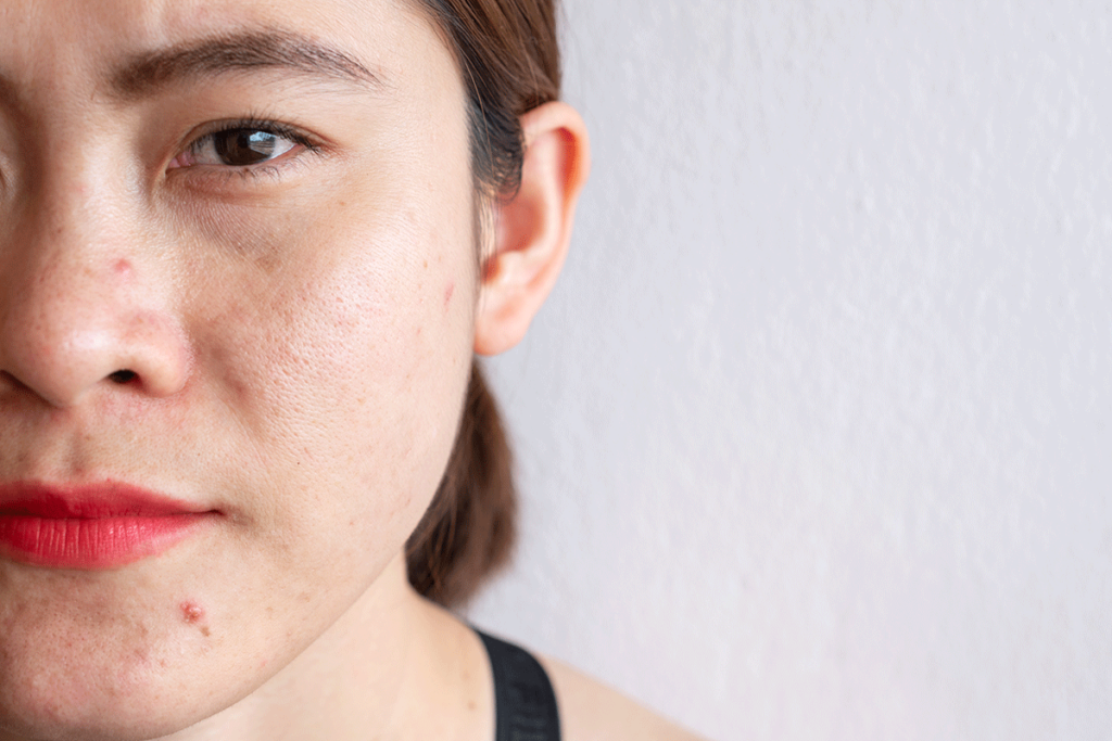 a womans acne is caused by her meth use