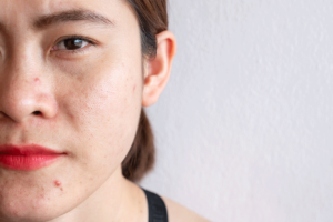 a womans acne is caused by her meth use